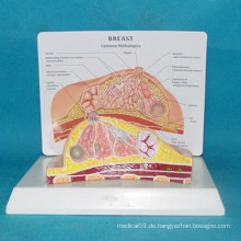Hochwertige pathologische Frauen Brust Anatomische Medizin Modell (R150105)